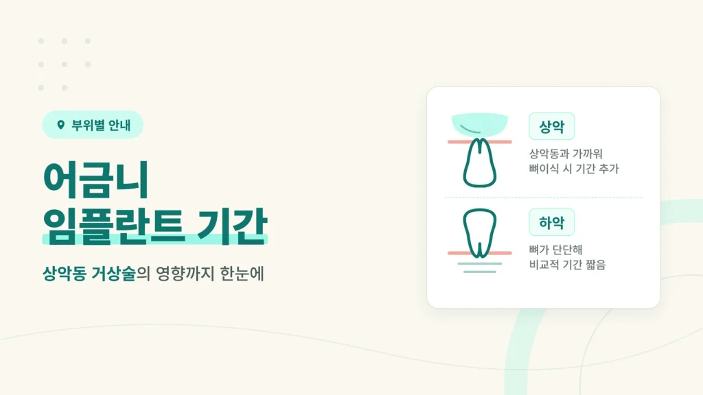어금니 임플란트 기간과 상악동 거상술이 미치는 영향 썸네일
